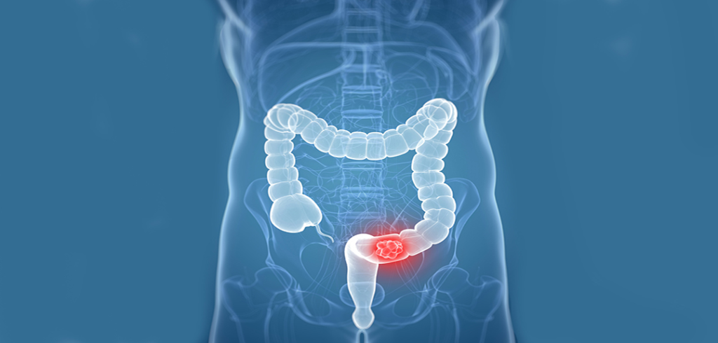 LEARN MORE ABOUT COLORECTAL CANCER
