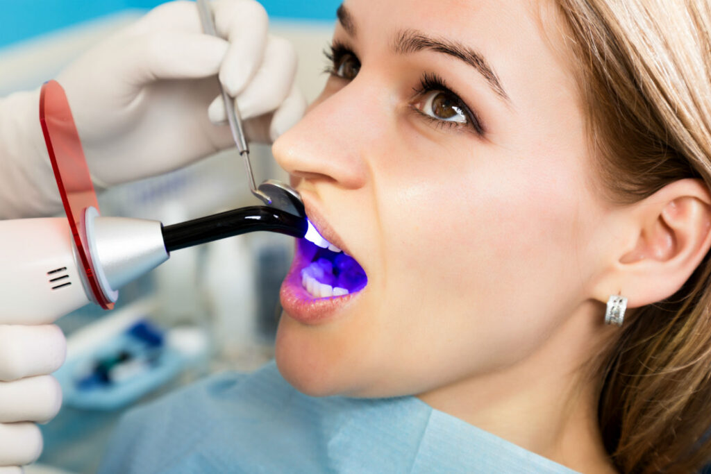 5 Benefits of Dental Bonding