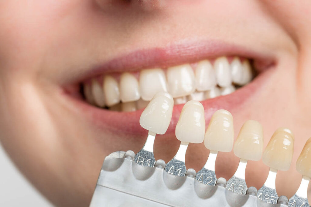 Things to Consider While Choosing Between Dental Implants and Veneers