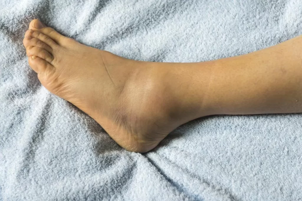 Unknown facts about leg swelling you need to be aware of