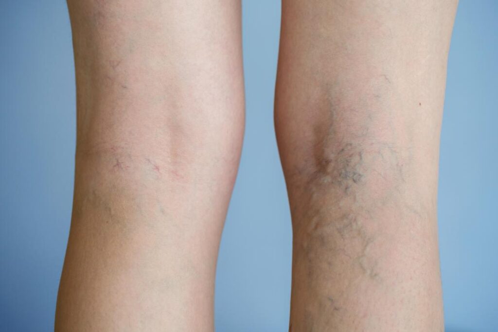 7 Tips to Relieve Varicose Veins Pain