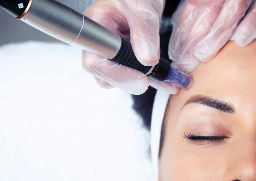 Enhance Your skin Aesthetics With Microneedling