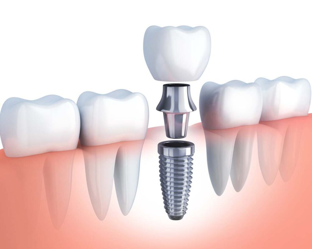 7 Benefits of Dental Implants
