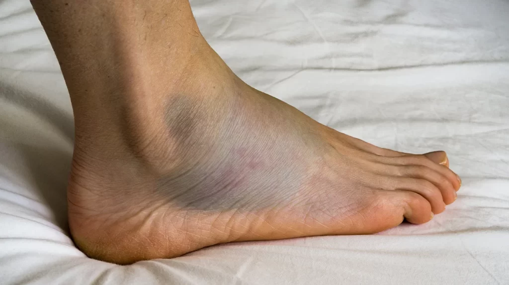 Simple Remedies for Swollen Feet