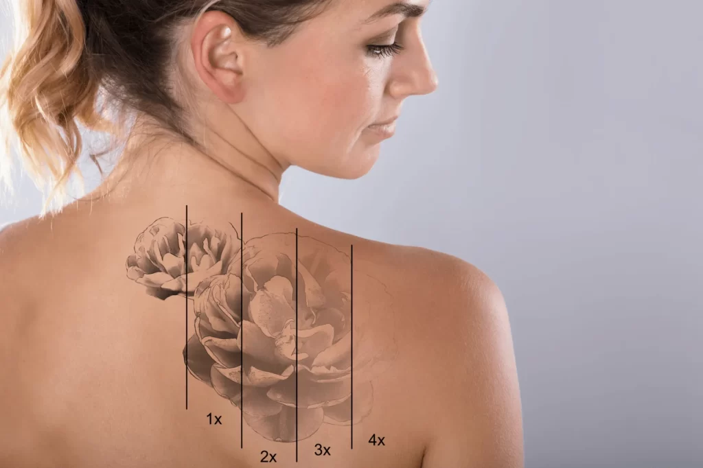 Removing Tattoos on Older Skin – Does Age Matter?