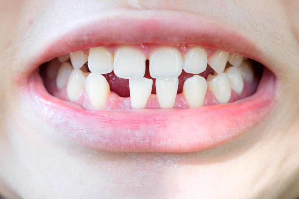 6 Benefits of Dental Implants For Missing Teeth