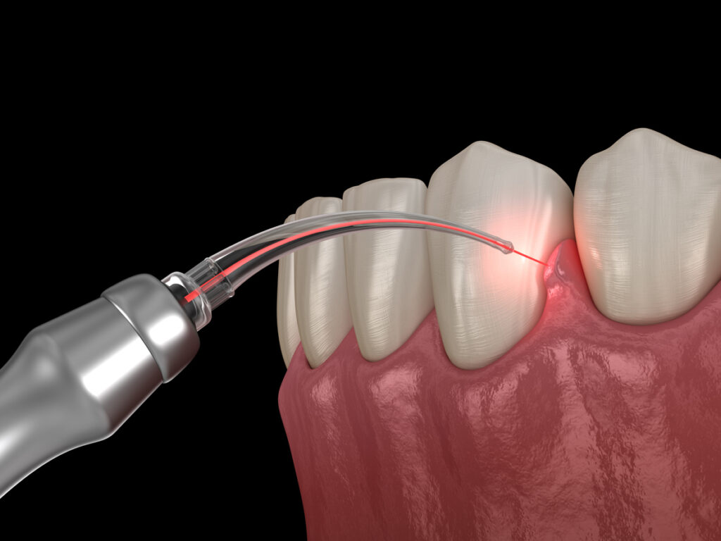 LANAP Surgeries -Answering All The Basic Questions!