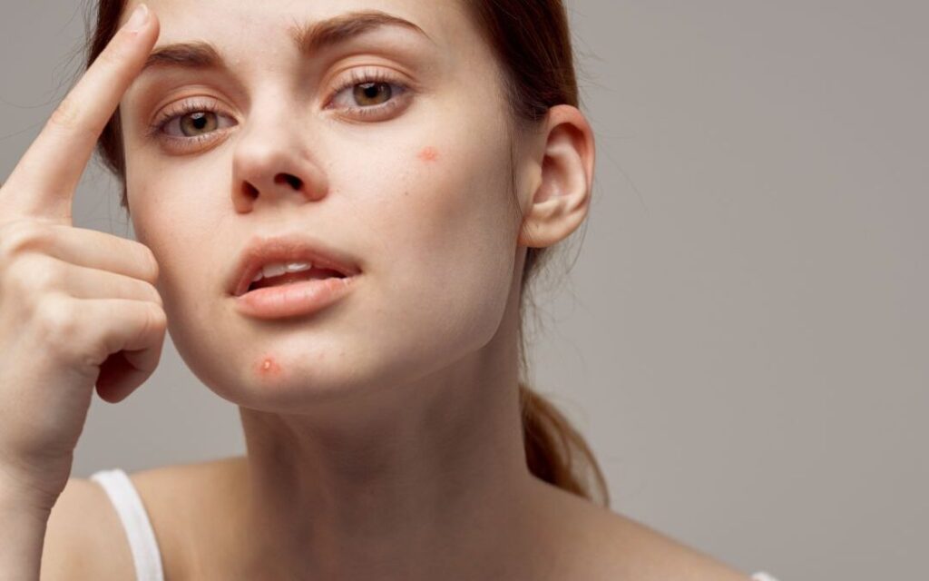 Acne Dermatology: Understanding, Treatment, and Management