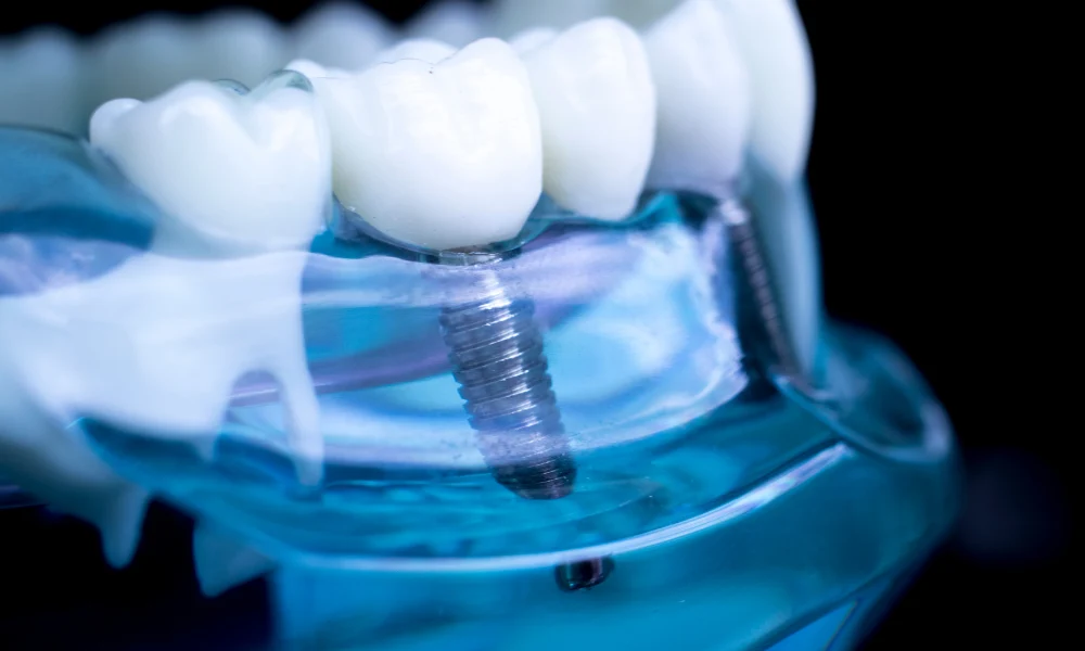 Dental Implants