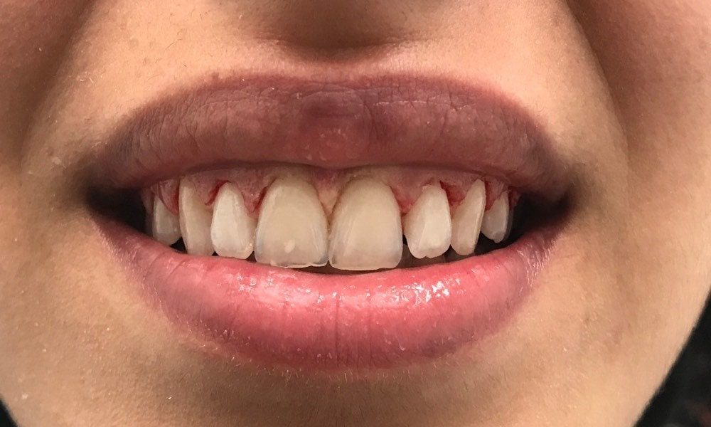 Gingival Hyperplasia