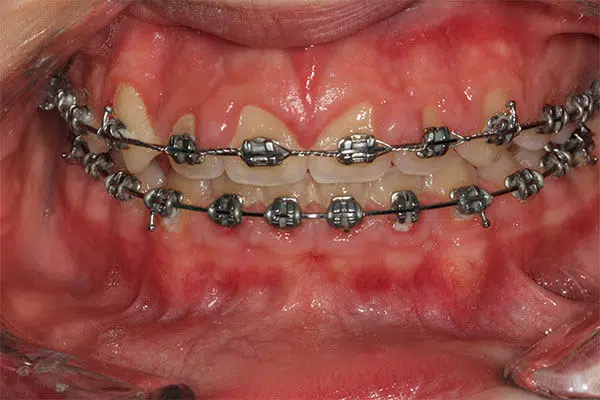 Gingival Hyperplasia