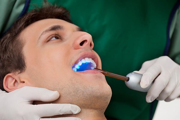 dental sealants