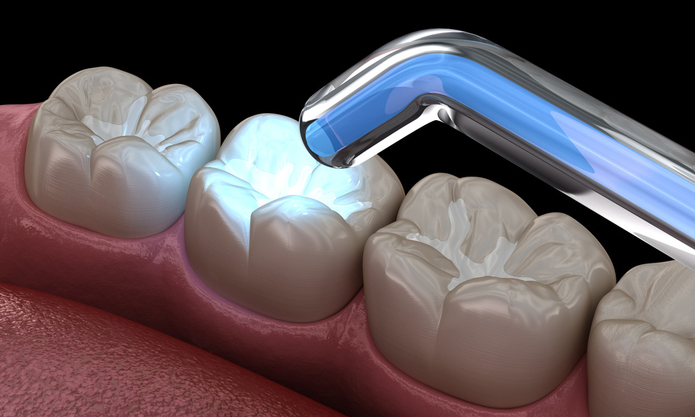 Dental Fillings