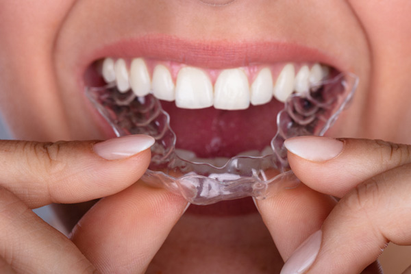 Invisalign