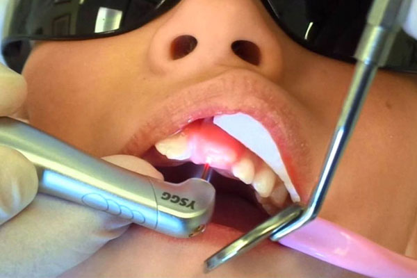 Laser Dentistry