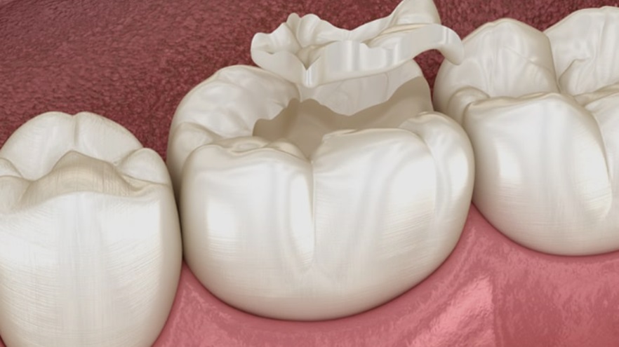 Tooth Fillings
