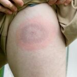 Lyme disease