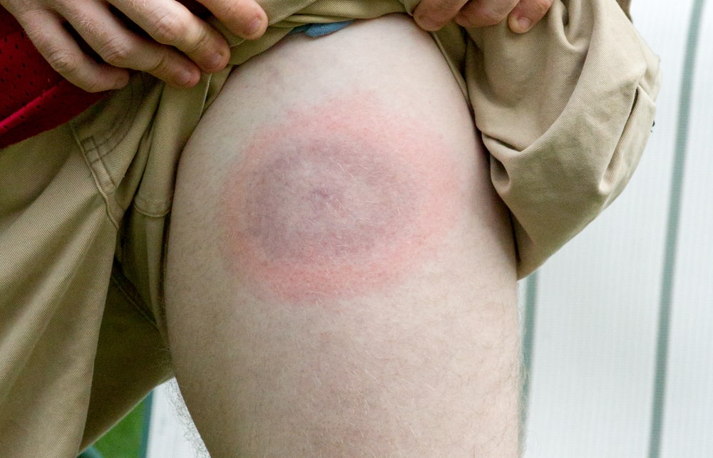 Lyme disease